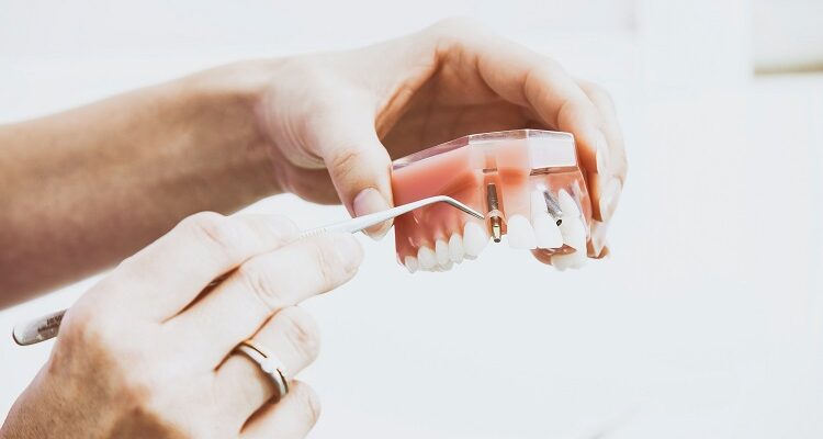 Dental Implants: What, Why, and How to Get One Done.