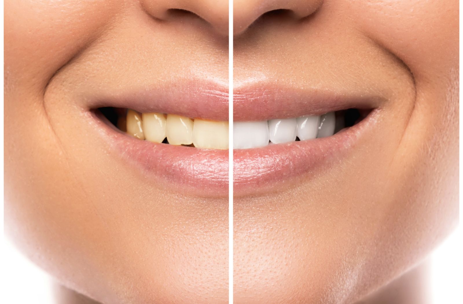 Zoom Whitening In Hamilton: Have A Successful Teeth Whitening Treatment!