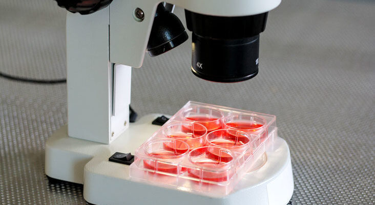 What Happens When a Person has a High Lymphocyte Count?
