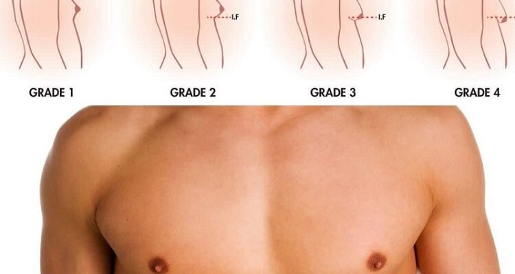 How Does Gynecomastia Surgery Work?