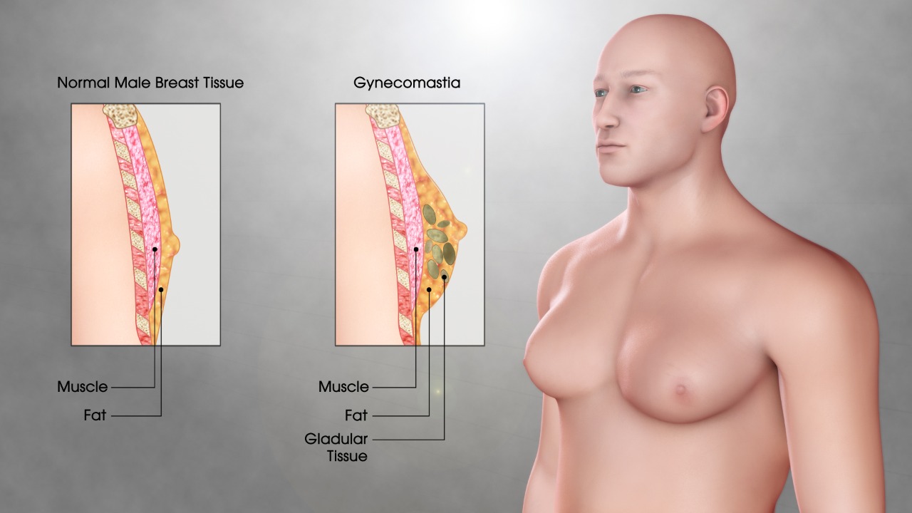 Benefits of Gynecomastia Surgery Gynaecomastia Treatment in Ludhiana