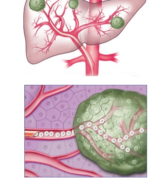 Liver Cancer Treatment: What is Chemoembolization?