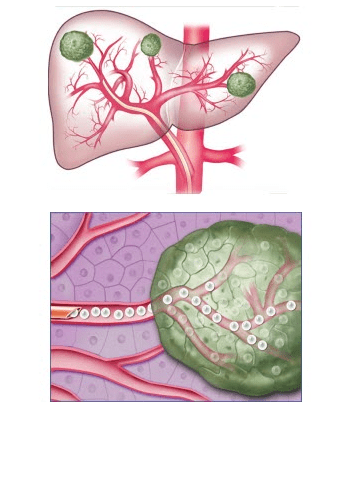 Liver Cancer Treatment: What is Chemoembolization?