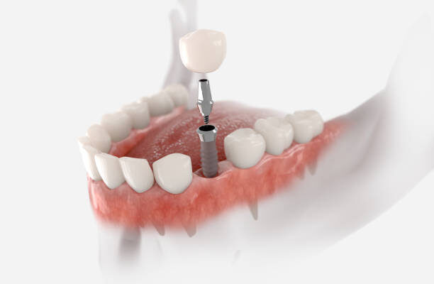 The Advantages of Dental Implants Over Traditional Dentures