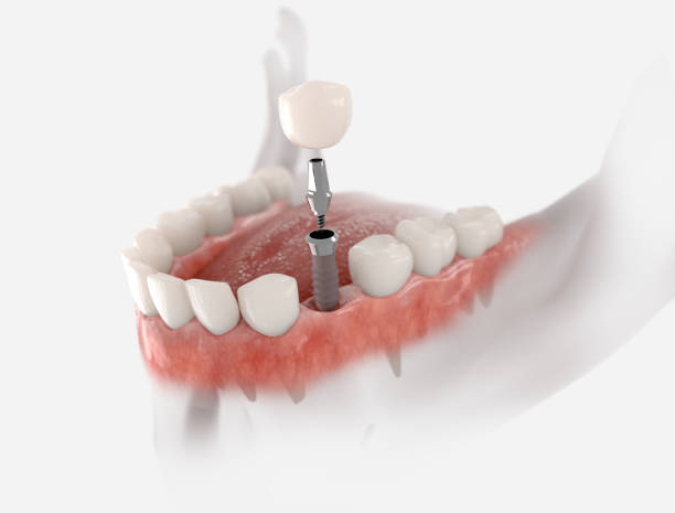 The Advantages of Dental Implants Over Traditional Dentures