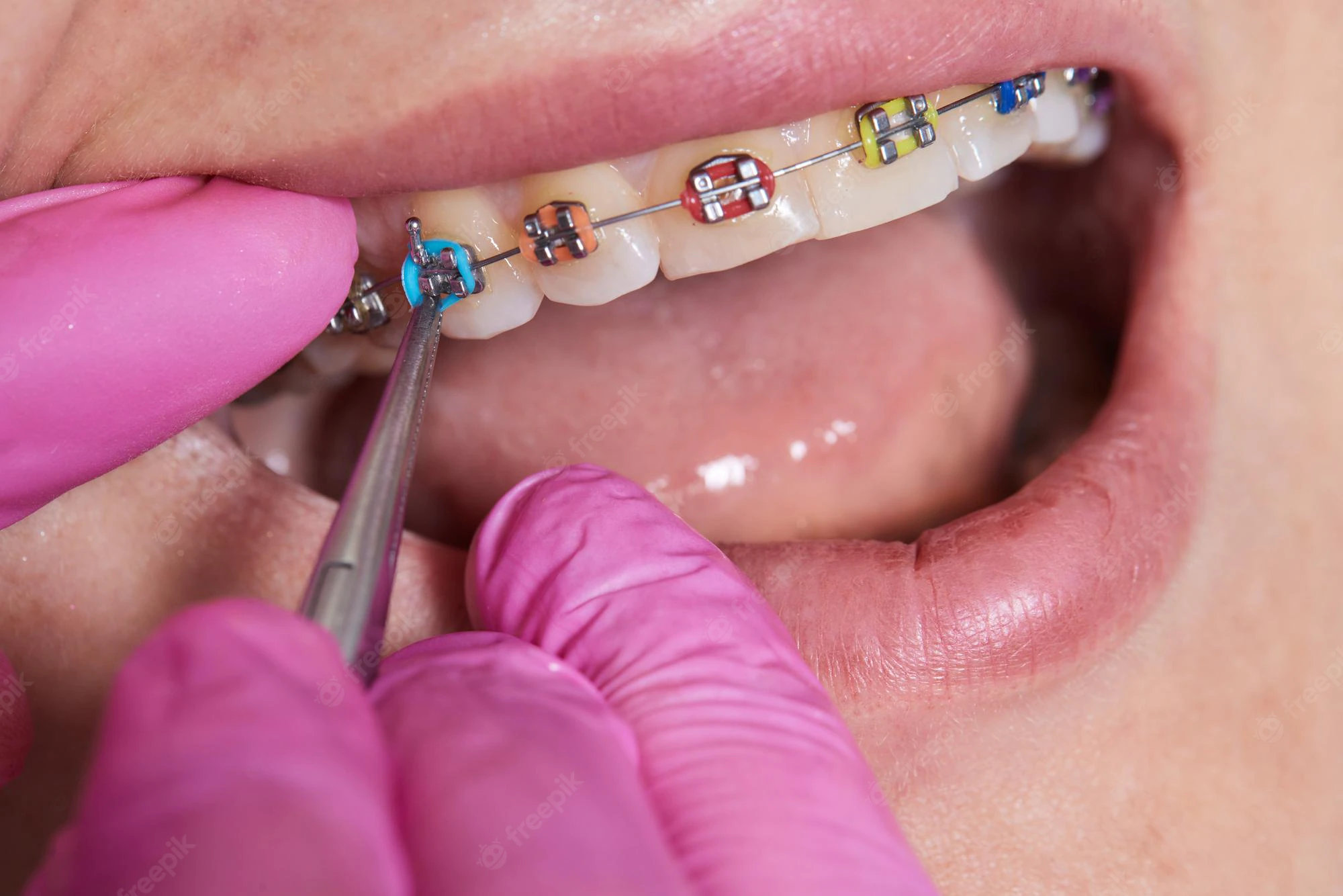 GUMS Procedure