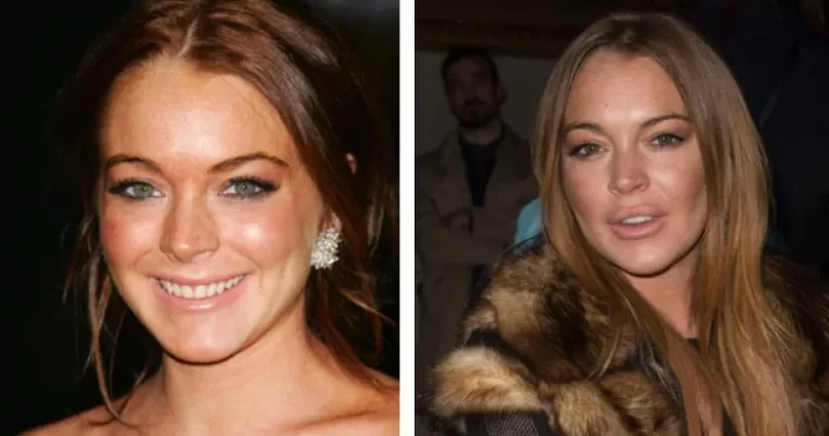 Why Lindsay Dee Lohan Had Plastic Surgery