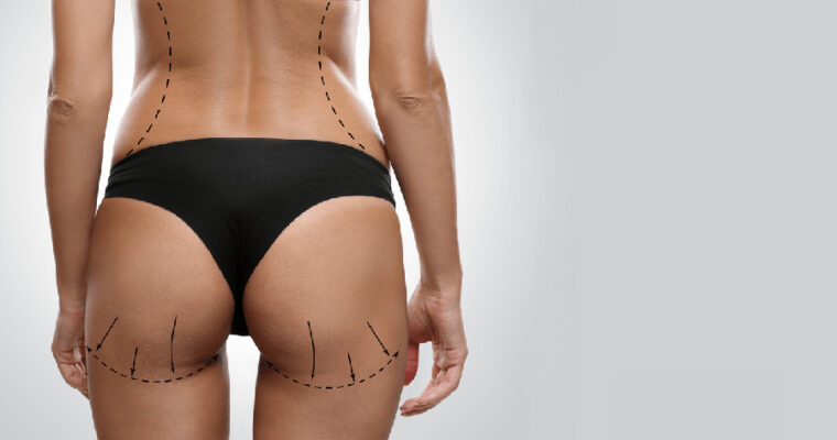 5 Myths About Brazilian Butt Lift Debunked