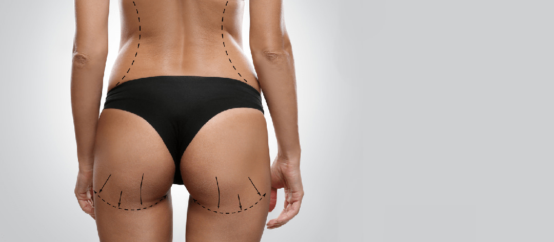 5 Myths About Brazilian Butt Lift Debunked